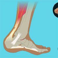 Bàn chân hình vòm ở người có ý nghĩa thích nghi như thế nào?