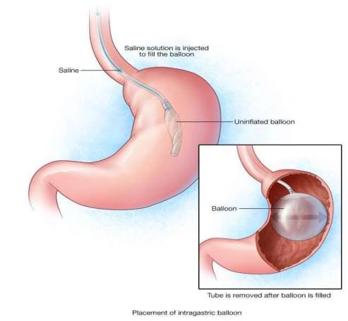 Hướng dẫn chẩn đoán và điều trị bệnh béo phì