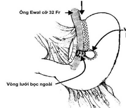 Hướng dẫn chẩn đoán và điều trị bệnh béo phì