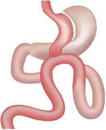 Hướng dẫn chẩn đoán và điều trị bệnh béo phì