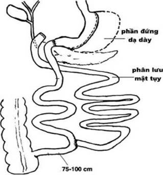 Hướng dẫn chẩn đoán và điều trị bệnh béo phì