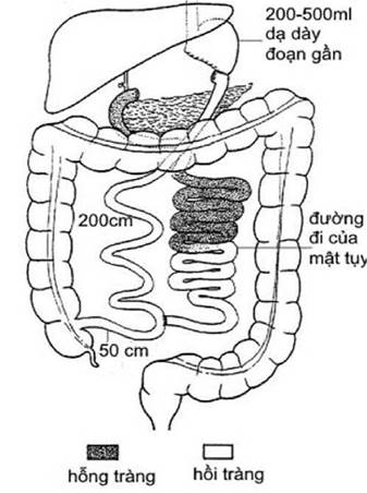 Hướng dẫn chẩn đoán và điều trị bệnh béo phì
