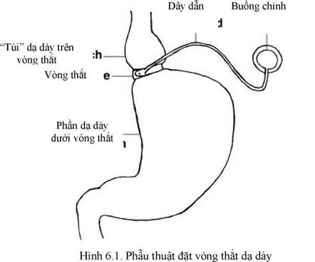 Hướng dẫn chẩn đoán và điều trị bệnh béo phì