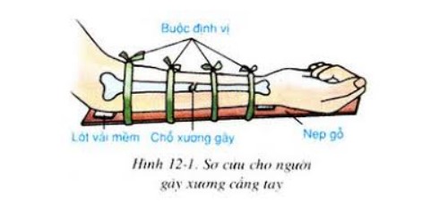 Giáo án STEM Sinh học 8 chủ đề Sơ cứu và băng bó cho người bị gãy xương