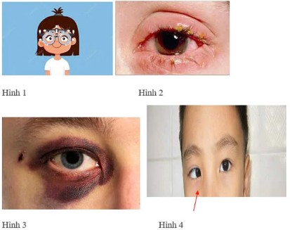 Đáp án cuộc thi chăm sóc mắt và phòng chống suy giảm thị lực ở học sinh tiểu học